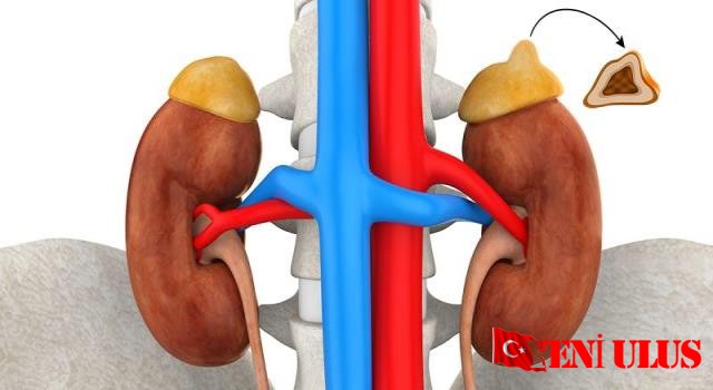 Feokromositoma Belirtileri ve Tedavisi