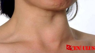 Zehirli Guatr Dikkat Edilmesi Gereken Bir Hastalık