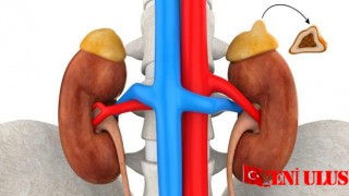Feokromositoma Belirtileri ve Tedavisi